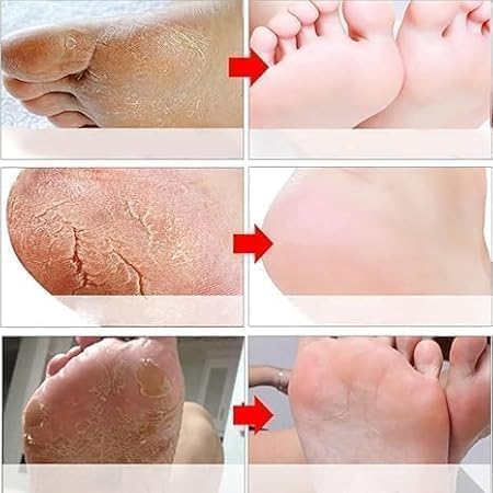 Moisturizing Foot Peel Mask for Cracked Dry Feet – Goat Milk (2 Pack)